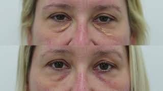 Xanthelasma removal treatment demo and results  see beforeafter photos [upl. by Lahcim]