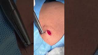 Sebaceous Cyst Excision [upl. by Milburr]