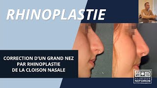 Correction dun grand nez par rhinoplastie de la cloison nasale  Dr Niforos à Lyon [upl. by Jackqueline439]