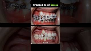 40 months for this braces Crowded teeth braces orthodontist dentist dentistry [upl. by Ateuqram]