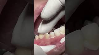 Zirconia crowns after root canal treatment of teeth dentaltreatment [upl. by Rhett359]