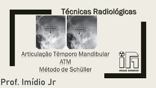 Articulação Têmporo Mandibular  ATM  método de Schüller [upl. by Hahsi801]