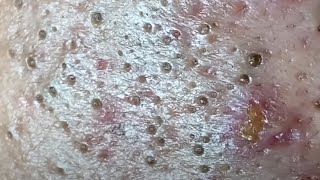 Blackheads amp Whiteheads Satisfying Removal 0035 [upl. by Gleda233]