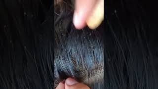 How to remove nits lice eggs piojos lice howtogetridoflice headliceremoval [upl. by Lleirbag]