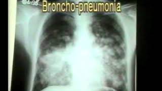 352 Pneumonia Bronchopneumonia  Chest XRays  Dr Vaidya [upl. by Nessej]