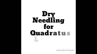 Dry Needling for Quadratus Lumborum [upl. by Langley972]