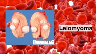 leiomyoma [upl. by Hadleigh]