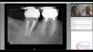 La chirurgie endodontique  le choix de la conservation [upl. by Yevi]