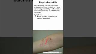 Atopic dermatitis eczema [upl. by Can]