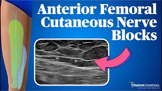 Anterior Femoral Cutaneous Nerve Block The Cuties [upl. by Aihsyla]